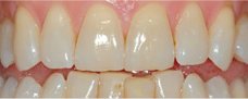 teeth1